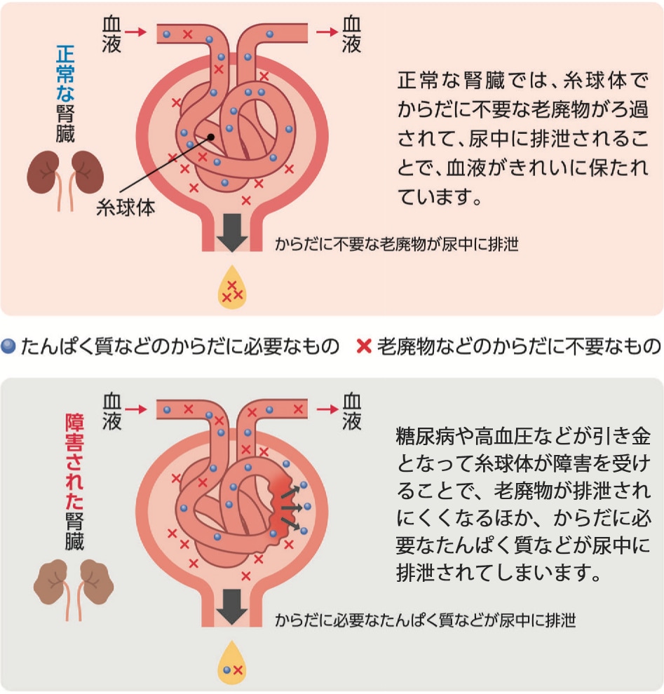 正常な腎臓と障害された腎臓