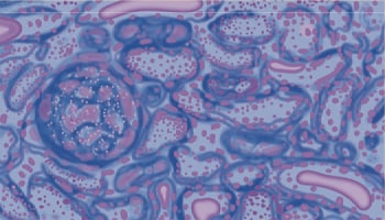 障害が起こっている腎臓の組織